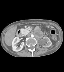 Neuroendocrine Tumor of the Pancreas Involves the Left Kidney - CTisus CT Scan