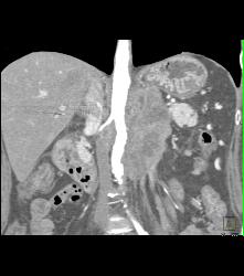 Neuroendocrine Tumor of the Pancreas Involves the Left Kidney - CTisus CT Scan