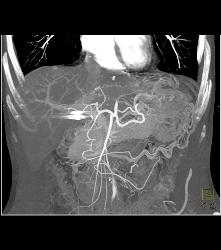 Neuroendocrine Tumor of the Pancreas Involves the Left Kidney - CTisus CT Scan