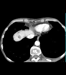 Neuroendocrine Tumor of the Pancreas Involves the Left Kidney - CTisus CT Scan