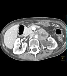 Neuroendocrine Tumor of the Pancreas Involves the Left Kidney - CTisus CT Scan