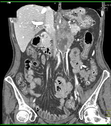 Neuroendocrine Tumor of the Pancreas Involves the Left Kidney - CTisus CT Scan