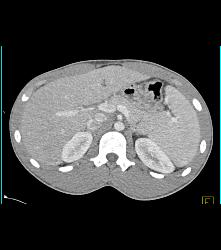 Laceration in the Pancreatic Tail - CTisus CT Scan