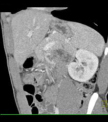 Laceration in the Pancreatic Tail - CTisus CT Scan