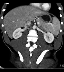 Laceration in the Pancreatic Tail - CTisus CT Scan