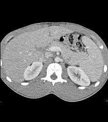 Laceration in the Pancreatic Tail - CTisus CT Scan