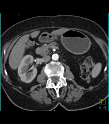 Carcinoma of the Pancreatic Head With Dilated Pancreatic Duct - CTisus CT Scan