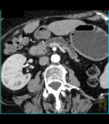 Carcinoma of the Pancreatic Head With Dilated Pancreatic Duct - CTisus CT Scan