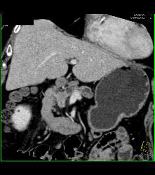 Carcinoma of the Pancreatic Head With Dilated Pancreatic Duct - CTisus CT Scan