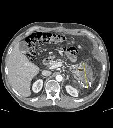 Post Operative Pseudocyst S/p Resection of the Pancreatic Tail - CTisus CT Scan