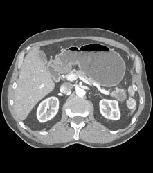 Cystadenoma of the Pancreatic Tail - CTisus CT Scan