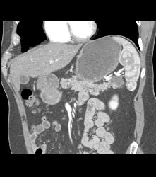 Cystadenoma of the Pancreatic Tail - CTisus CT Scan