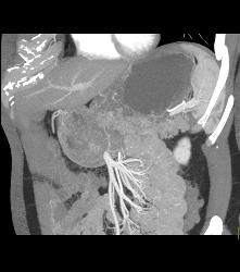 Cystadenoma of the Pancreatic Tail - CTisus CT Scan