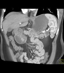 Cystadenoma of the Pancreatic Tail - CTisus CT Scan