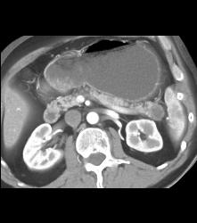 Cystadenoma of the Pancreatic Tail - CTisus CT Scan