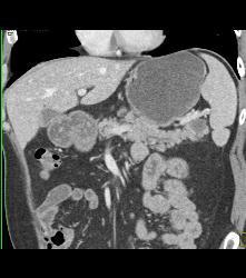 Cystadenoma of the Pancreatic Tail - CTisus CT Scan