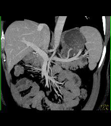 Cystadenoma of the Pancreatic Tail - CTisus CT Scan