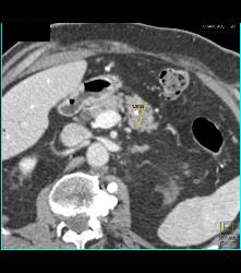 Pancreatic Cancer - CTisus CT Scan