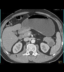 Intraductal Papillary Mucinous Neoplasm (IPMN) - CTisus CT Scan