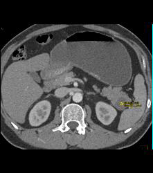 Intraductal Papillary Mucinous Neoplasm (IPMN) - CTisus CT Scan