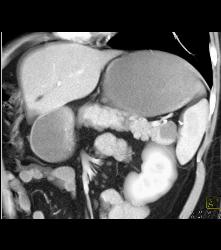 Intraductal Papillary Mucinous Neoplasm (IPMN) - CTisus CT Scan