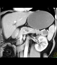 Intraductal Papillary Mucinous Neoplasm (IPMN) - CTisus CT Scan