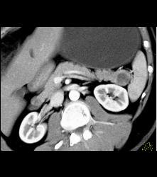 Intraductal Papillary Mucinous Neoplasm (IPMN) - CTisus CT Scan