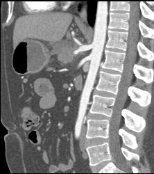 Pancreatic Cancer Encases the Celiac Axis - CTisus CT Scan