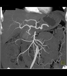 Pancreatic Cancer Encases the Celiac Axis - CTisus CT Scan