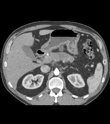 Pancreatic Cancer Encases the Celiac Axis - CTisus CT Scan