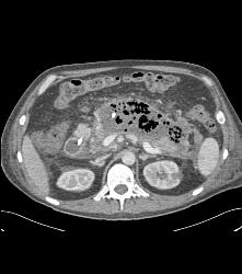 Pancreatic Necrosis With Abscess Involving the Psoas Muscle - CTisus CT Scan