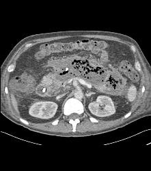 Pancreatic Necrosis With Abscess Involving the Psoas Muscle - CTisus CT Scan