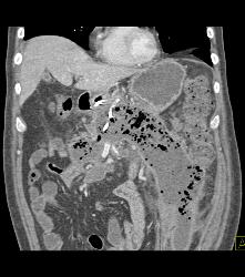 Pancreatic Necrosis With Abscess Involving the Psoas Muscle - CTisus CT Scan