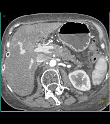 Pancreatic Cancer Encases the Celiac Artery and Invades the Portal Vein and Superior Mesenteric Vein (SMV) - CTisus CT Scan