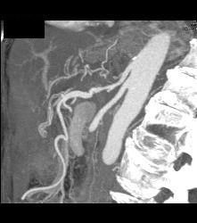 Pancreatic Cancer Encases the Celiac Artery and Invades the Portal Vein and Superior Mesenteric Vein (SMV) - CTisus CT Scan