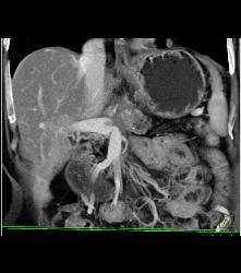 Pancreatic Cancer Encases the Celiac Artery and Invades the Portal Vein and Superior Mesenteric Vein (SMV) - CTisus CT Scan