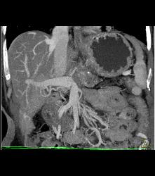 Pancreatic Cancer Encases the Celiac Artery and Invades the Portal Vein and Superior Mesenteric Vein (SMV) - CTisus CT Scan