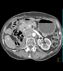 Pancreatic Cancer With Cystic Nodes - CTisus CT Scan