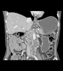 Pancreatic Cancer With Cystic Nodes - CTisus CT Scan