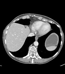 Pancreatic Cancer With Cystic Nodes - CTisus CT Scan