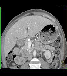 Chronic Pancreatitis With Stone in Pancreatic Duct - CTisus CT Scan