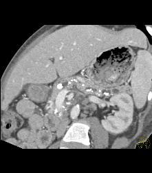 Chronic Pancreatitis With Stone in Pancreatic Duct - CTisus CT Scan