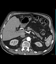 Pancreatic Cancer With Atrophy of the Pancreatic Gland - CTisus CT Scan