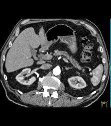 Pancreatic Cancer With Atrophy of the Pancreatic Gland - CTisus CT Scan