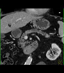 Pancreatic Cancer With Atrophy of the Pancreatic Gland - CTisus CT Scan