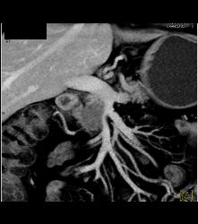 Pancreatic Cancer Encases the PV/SMV Confluence - CTisus CT Scan