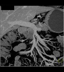 Pancreatic Cancer Encases the PV/SMV Confluence - CTisus CT Scan