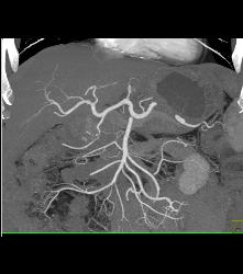 Pancreatic Cancer Encases the PV/SMV Confluence - CTisus CT Scan