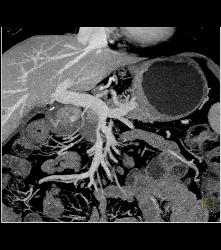 Pancreatic Cancer Encases the PV/SMV Confluence - CTisus CT Scan