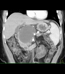 Pseudocyst With Collateral Vessels - CTisus CT Scan